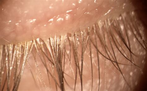 example of a patient with Demodex folliculorum. Note the cylindrical... | Download Scientific ...