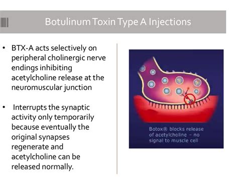 Botulinum toxin type A injections