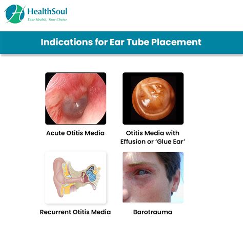 Ear Infection Tubes Adults at William Clayson blog