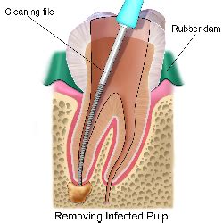 Root Canal Treatment, Get Root Canal Therapy