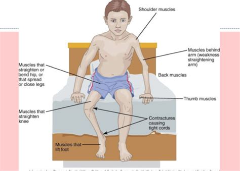 Poliomyelitis and Post-polio syndrome Flashcards | Quizlet