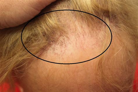 Frontal fibrosing alopecia causes, symptoms, diagnosis, treatment ...