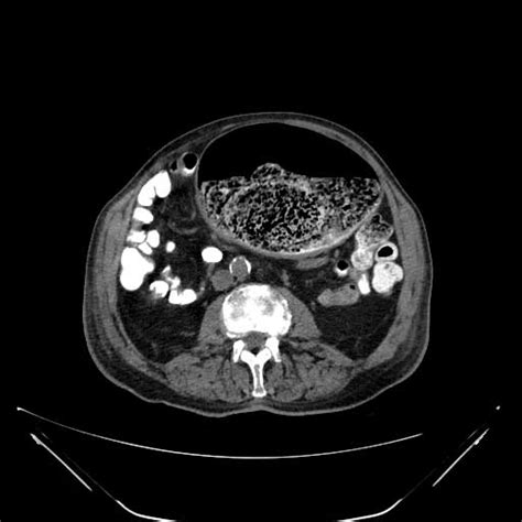 Stercoral Colitis | Definition, Radiology, Treatment | Learn from doctor