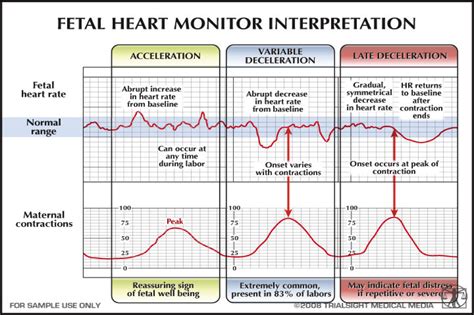 early vs late deceleration - Google Search | Nursing school tips ...