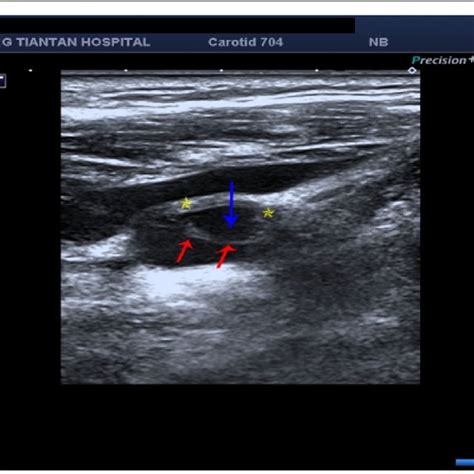 The carotid web was extensive intima fibroid hyperplasia (yellow arrow ...