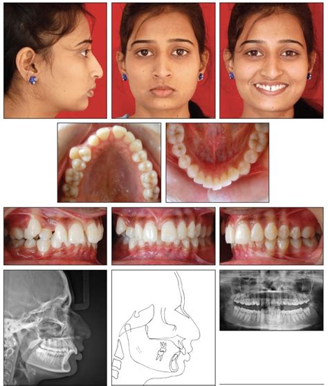 Orthodontic Management of Class II Malocclusion with Unilateral Transposition - JCO Online ...