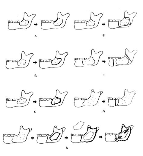 Diagrammatic representation of the various surgical treatment of the ...