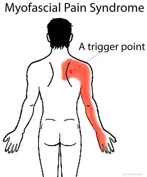 Shoulder / ПЛЕЧИ: Shoulder Blade (Scapula) Pain