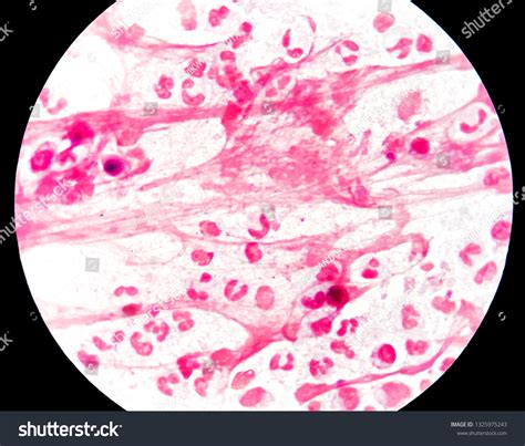 Smear Sputum Specimen Grams Stained Under Stock Photo 1325975243 ...