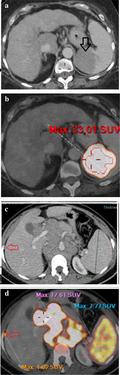 Beyond lymph nodes: 18F-FDG PET/CT in detection of unusual sites of extranodal lymphoma ...