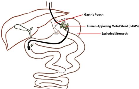 EUS-directed transgastric ERCP in Roux-en-Y gastric bypass revision of sleeve gastrectomy - VideoGIE