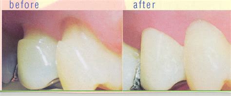 Gumline Cavity Restoration | South Portland, ME | Palmer & Krause DDS