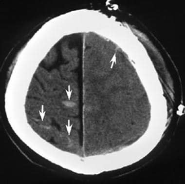 Brain Contusion Imaging: Practice Essentials, Computed Tomography ...