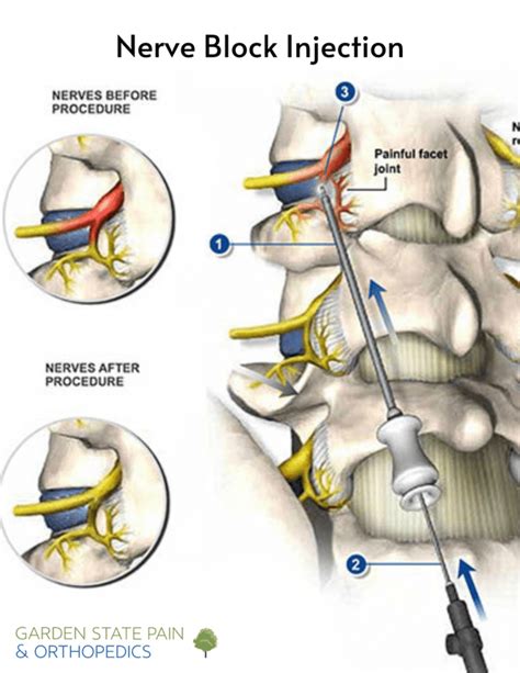 Overcoming Back Pain - Types of Spinal Injections | Orthopedics and Pain Medicine Physician ...