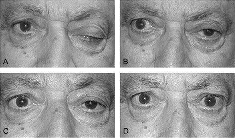 The Ice Pack Test in the Differential Diagnosis of Myasthenic Diplopia - Ophthalmology