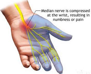 Paresthesia; Dysesthesia