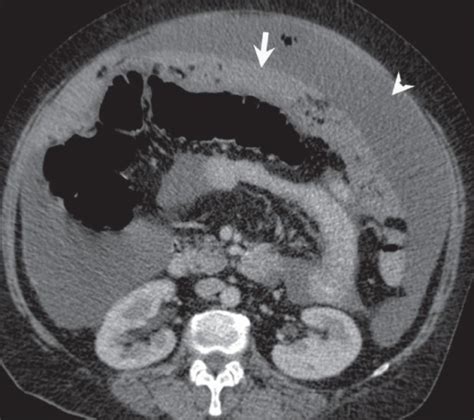 Peritoneal carcinomatosis. Omental caking (arrow) and a | Open-i