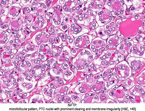 Pathology Outlines - Noninvasive follicular thyroid neoplasm with papillary-like nuclear ...