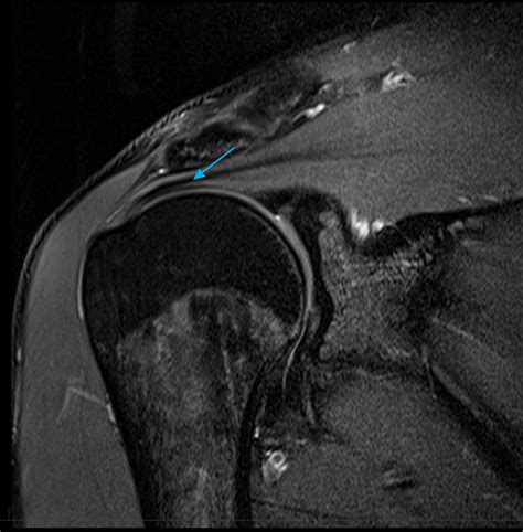 MRI Shoulder - Musculoskeletal Imaging