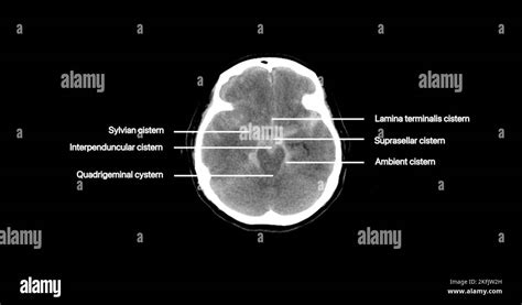 Subarachnoid haemorrhage, CT scan Stock Photo - Alamy