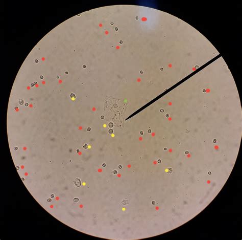 RBC(red) WBC(yellow) Epi cell(green) in urine sample ; 40x | Medical laboratory technician ...