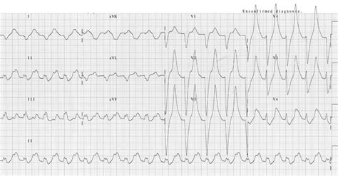 Hyperkalaemia ECG changes • LITFL • ECG Library