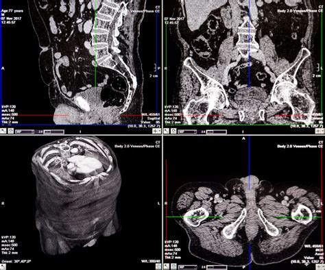 What is a Lumbar Spine CT scan? | Two Views