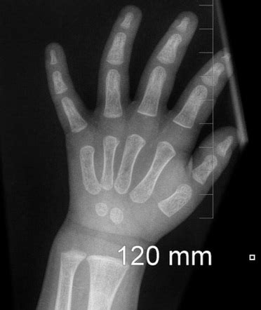 Normal wrist and hand x-ray - 2-year-old | Image | Radiopaedia.org