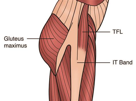 Tensor Fascia Latae Dysfunction and Sciatica