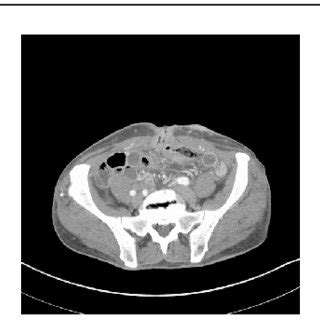 (PDF) Colocutaneous Fistula as a Result of Chronic Hidradenitis Suppurativa