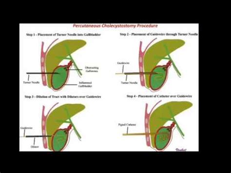 Percutaneous Cholecystostomy