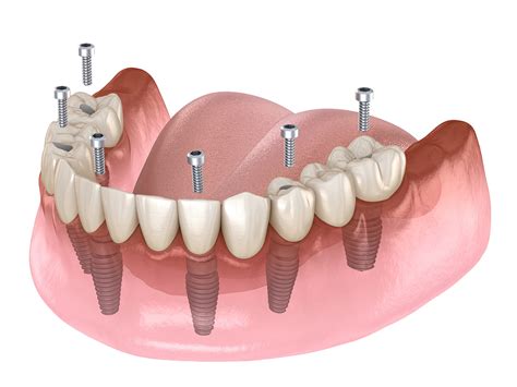 All-On-4 Dental Implants - Artistic Dentistry