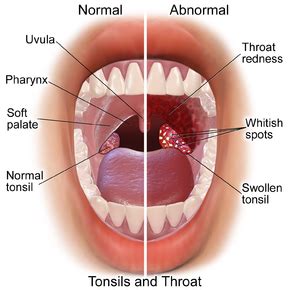 Tonsillitis - Wikipedia