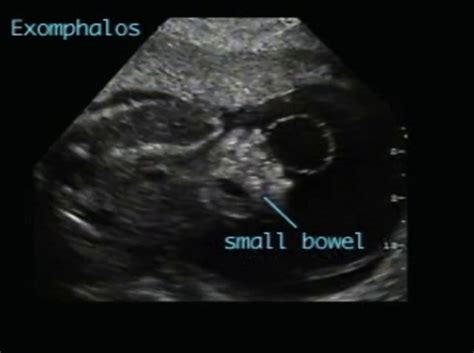 Beckwith-Wiedemann syndrome – ULTRASOUNDPAEDIA