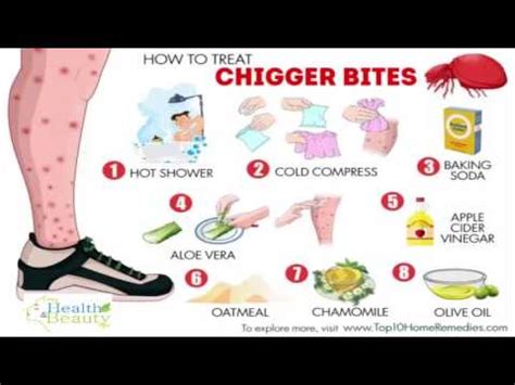 How to Treat Chigger Bites - YouTube