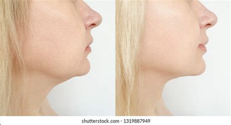 Woman Before After Chin Fat Correction Stock Photo 1197063781 ...