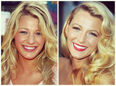 Blake Lively Before and After Braces | Hoyt Dental | Murrieta ...