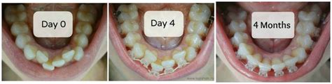 14 best Radiance Plus Clear Sapphire Braces - Before and After images on Pinterest | Sapphire ...