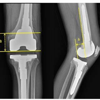 Adductor Tubercle X Ray