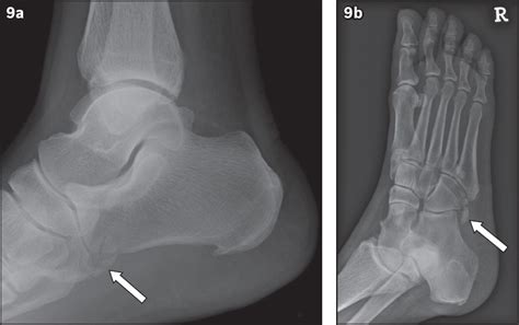 Common accessory ossicles of the foot: imaging features, pitfalls and associated pathology | SMJ