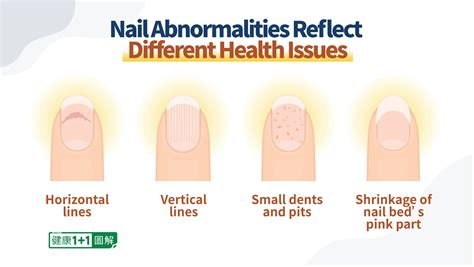 8 Nail Conditions and What They Mean for Your Health Nail Cuticle, Cuticle Oil, Gel Manicure ...