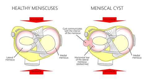 What is a Meniscal Cyst? Why You Should Care About the Hole in My ...