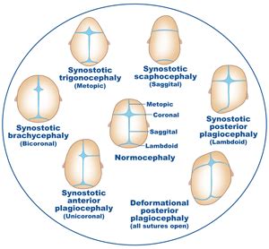 Craniosynostosis | Symptoms, Diagnosis & Treatment