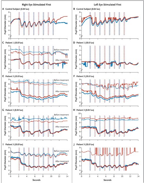 Representative Results of Pupillometry in a Control Subject and before... | Download Scientific ...