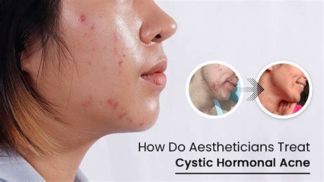 How Do Aestheticians Treat Cystic Hormonal Acne