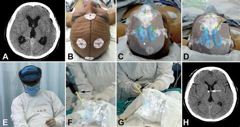 External Ventricular Drain Mri Safety - Best Drain Photos Primagem.Org