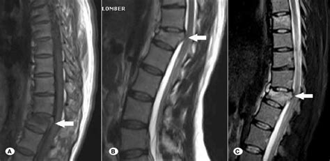 Anterior Longitudinal Ligament Mri