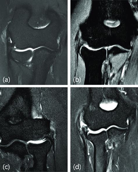 a. 41-year-old woman with tendinosis of the common extensor tendon ...