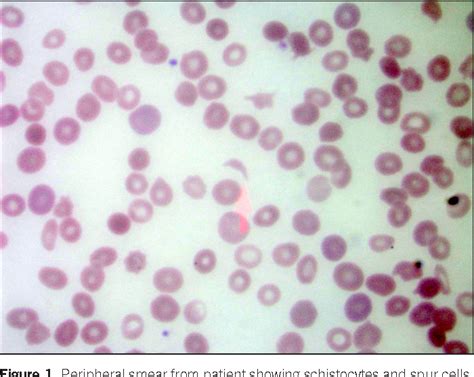 Hemolysis in Acute Alcoholic Hepatitis: Zieve's Syndrome - Semantic Scholar