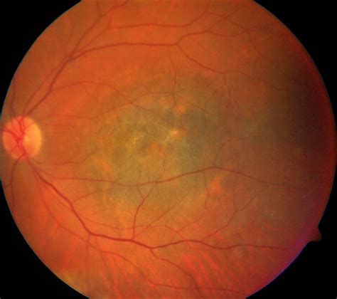 Association Between Uveal Melanoma and Myotonic Dystrophy: A Series of 3 Cases | Genetics and ...